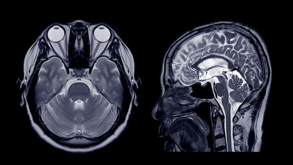 MRT-Aufnahme eines menschlichen Gehirns